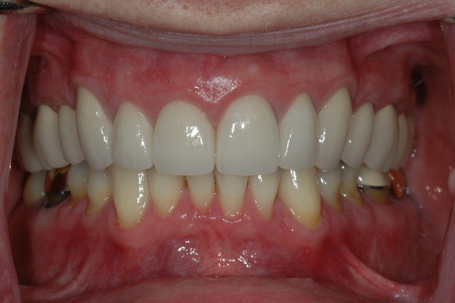 AFTER - Restored upper teeth with Crowns/Veneers - Prosthodontics on Chamberlain