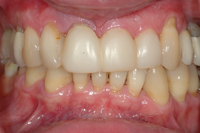 Case 2 - BEFORE - Failing Upper Teeth
