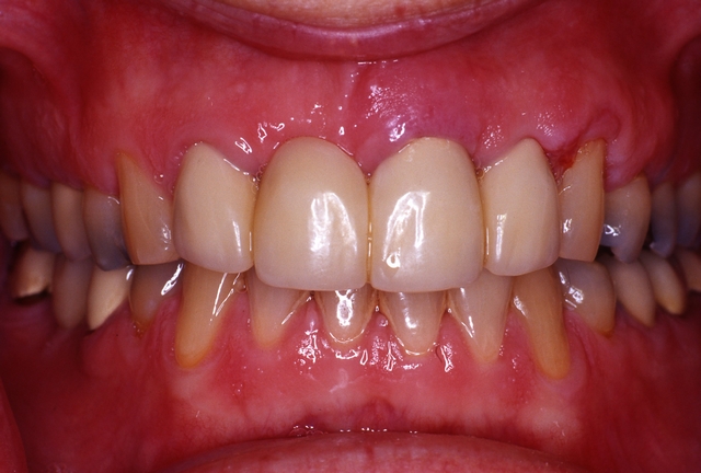 CASE 3 -BEFORE with old crowns
