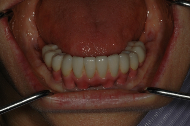 Case 3 - AFTER - Lower Bridge seated on Implants