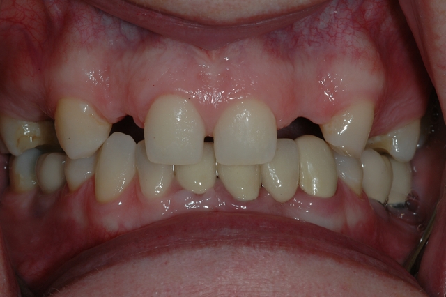CASE 1 -BEFORE - Missing and Small Teeth
