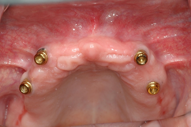 CASE 1 -BEFORE with 4 implant posts 