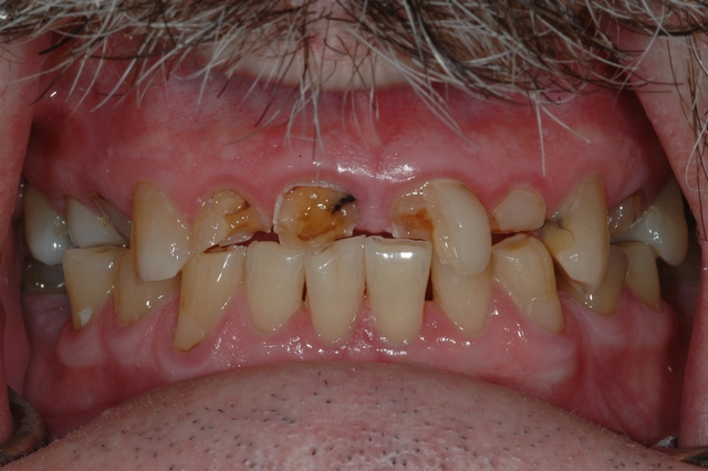 Case 1 - BEFORE - Heavy wear on upper teeth 