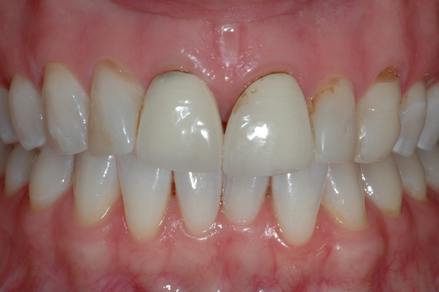 CASE 4 - BEFORE -Heavily stained upper composites 