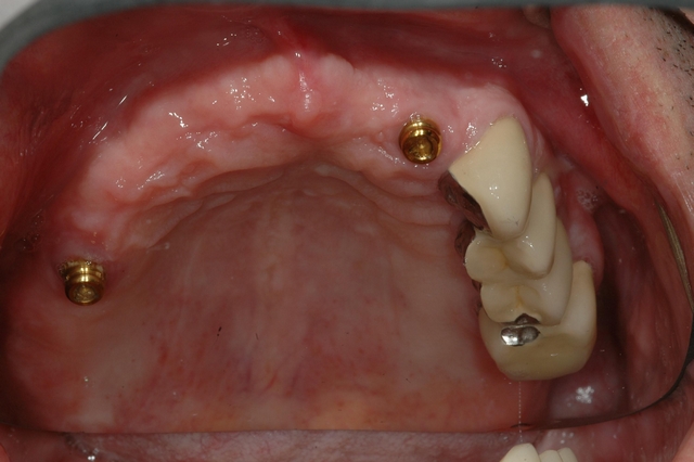 CASE 1 -BEFORE -two upper implant posts