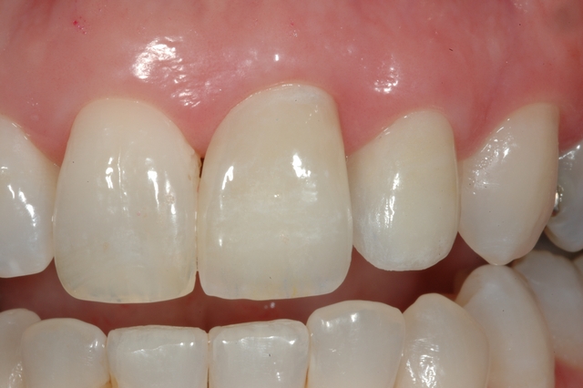 CASE 2 -AFTER restored with two new crowns