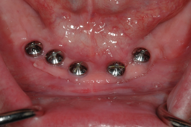 Case 1 - After - Lower Implants Ready to Restore 