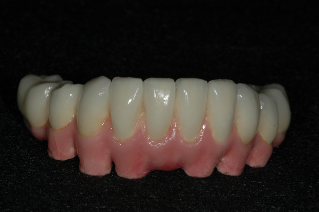 Case 3 - Final Ceramic bridge with pink gingiva