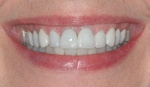 AFTER - Restored with Ceramic Crowns and Veneers - Dr. Stewart Hum