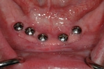 AFTER - 5 lower dental implants ready to restore. 