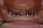 BEFORE - Lower 5 Implants Ready to Restore - Dental Implants Bridge - Prosthodontics on Chamberlain - Ottawa Implants