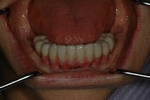 AFTER - Lower Restored with Full Bridge - Dental Implants Bridge - Prosthodontics on Chamberlain 