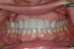 AFTER -Final restorations of implants, crowns and ceramic veneers
