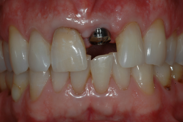 BEFORE - Single implant with abutment and discoloured central incisor - OTTAWASMILE