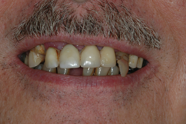 CASE 2 - BEFORE IMAGE - Failing upper/lower teeth 
