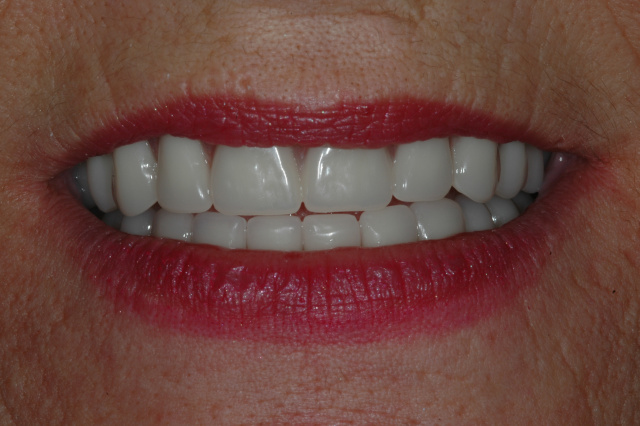 CASE 3 -AFTER -New Smile with Dentures