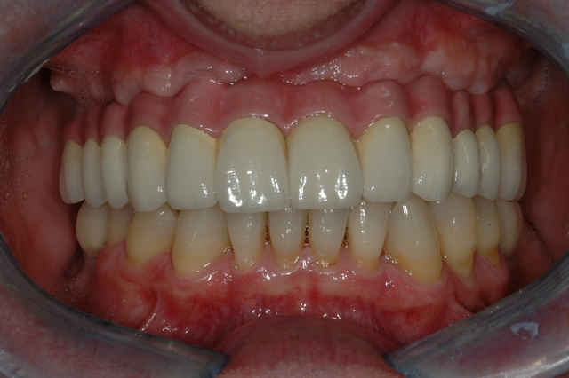 Case 2 - AFTER - Final Upper Implant-Bridge 