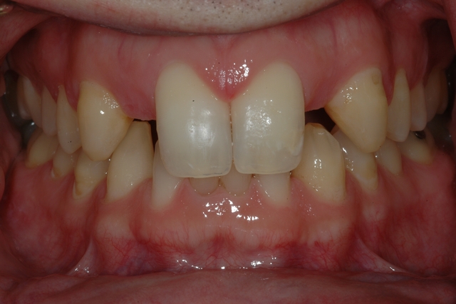 CASE 1 -BEFORE with missing lateral incisors