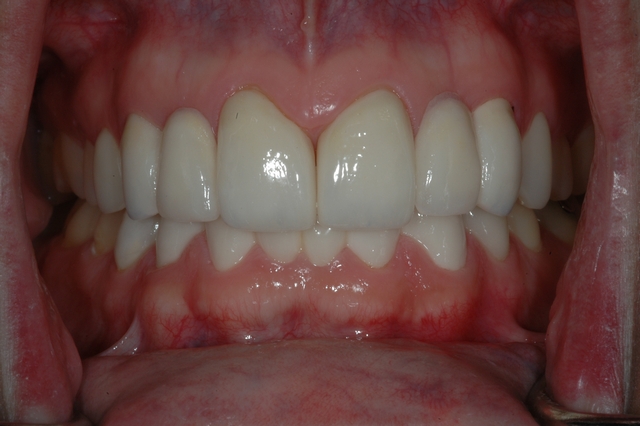 CASE 2 -AFTER with ceramic bridges