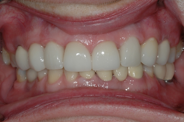 CASE 1 -AFTER -Ceramic Veneers and Single Implants