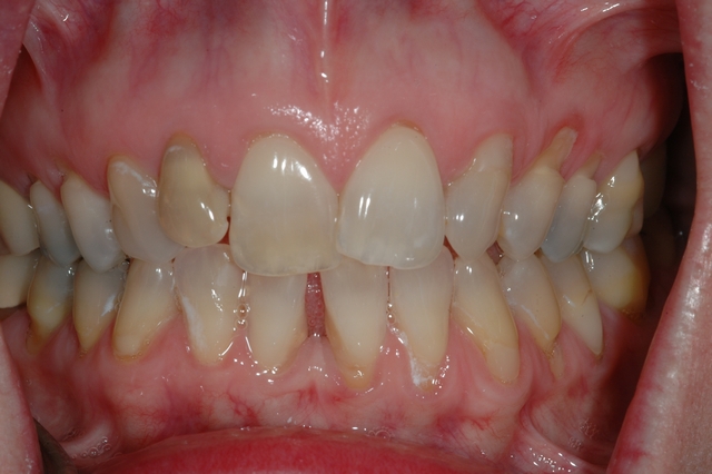 CASE 1 -BEFORE -Discoloured teeth
