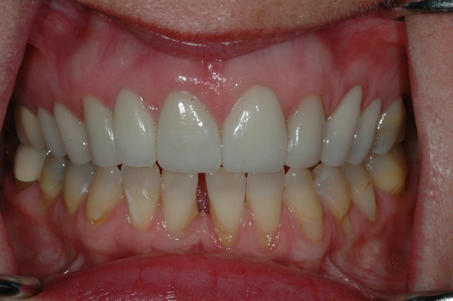 CASE 1 -AFTER -Ceramic Veneers 