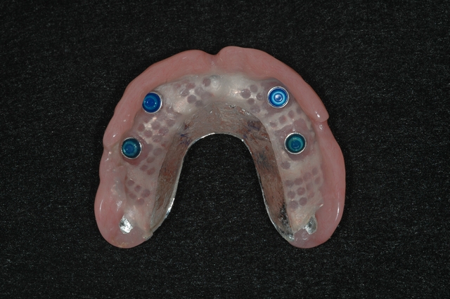 CASE 1 -AFTER IMAGE - denture with implant clips 