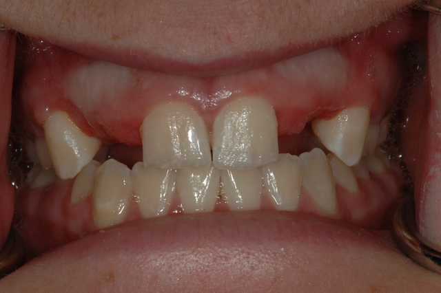 CASE 1 -BEFORE with missing lateral incisors