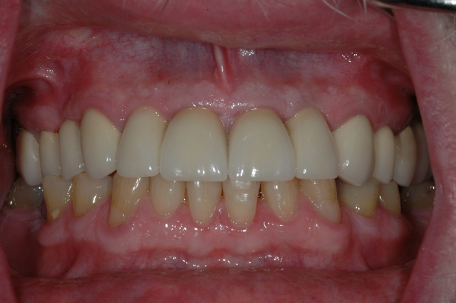 Case 1 - AFTER - Final upper crowns and implants