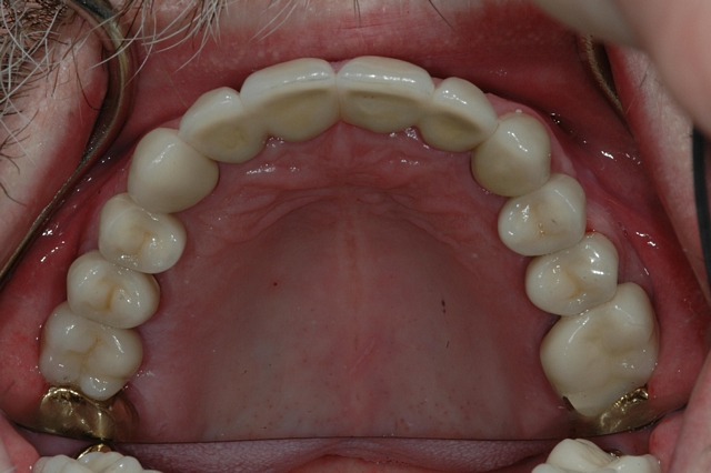 Case 1 - AFTER - Crowns on all upper teeth