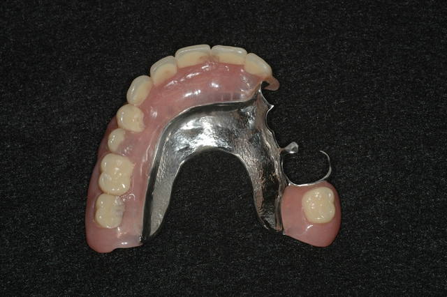 CASE 1 -AFTER -partial denture