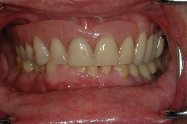 CASE 1 -AFTER with partial denture