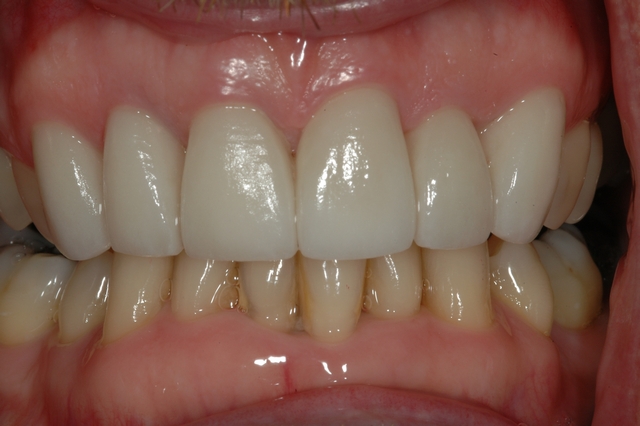 CASE 2 -AFTER with ceramic veneers