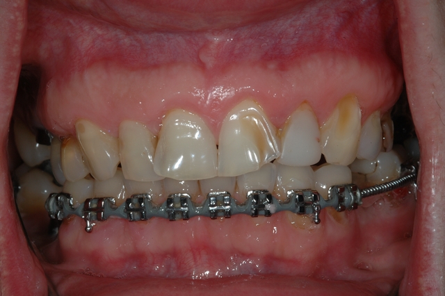 BEFORE - pre-treatment of eroded, crowded teeth with braces.