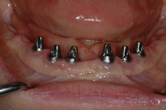Case 3 - BEFORE - Lower Implants ready to Restore