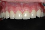 AFTER -Prosthodontics on Chamberlain -completed treatment with ceramic veneers