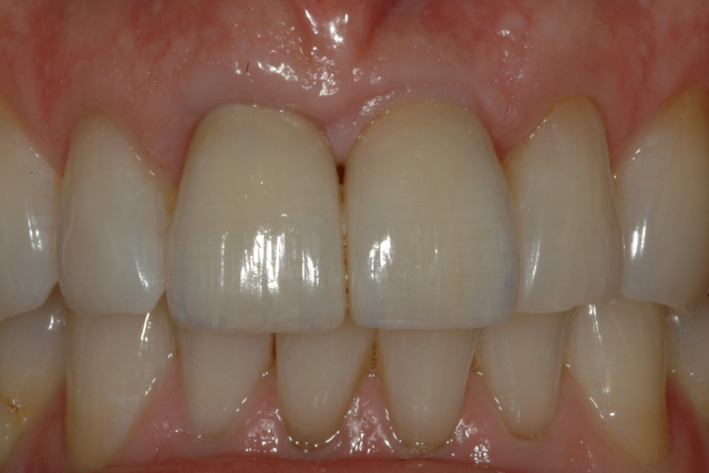AFTER - Final ceramic crowns on central incisor and single implant - OTTAWASMILE