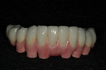 AFTER - The Lower Ceramic Bridge - Dental Implants Bridge 