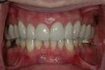 AFTER - Restored with Crowns Prosthodontics on Chamberlain 