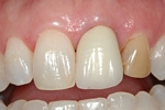 BEFORE - Discoloured Upper Incisors - Prosthodontics on Chamberlain 