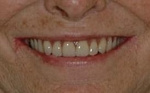 AFTER - New smile with Dentures and 2 lower implants