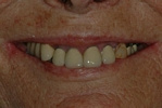 BEFORE - Reconstuction of unhealthy, crowded teeth