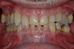 BEFORE -Failing upper/lower teeth due to Bruxism/Grinding