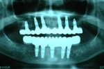 BEFORE - Radiograph of Full Mouth Implants - Ottawasmile