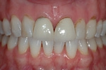 BEFORE - Older Upper Crowns and Veneers - Prosthodontics on Chamberlain