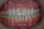 AFTER - 6 New Ceramic Crowns and Veneers - Prosthodontics on Chamberlain - Ottawa Implants