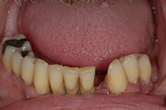 BEFORE - Periodontally failing teeth, hopeless prognosis 