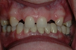 BEFORE - Upper Missing Teeth with Small Teeth - Dental Implants for Single Teeth - Prosthodontics on Chamberlain 