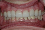 AFTER - Upper Spaces Restored with Implants, Ceramic Veneers on the Teeth - Prosthodontics on Chamberlain