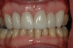 AFTER - 6 Upper Teeth Restored - Ceramic Veneers - Prosthodontics on Chamberlain - Ottawa Implants